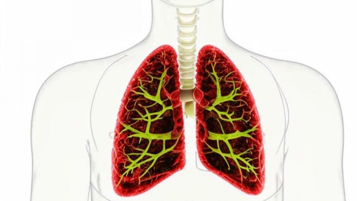 Микоплазменная пневмония: как распознать и лечить